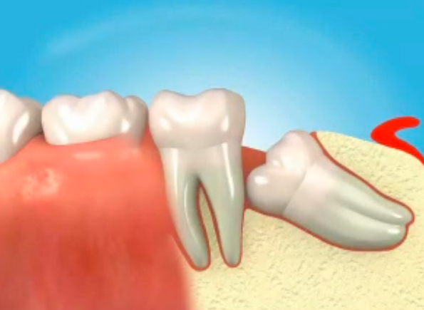 Wisdom Tooth